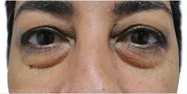 Close-up of a person's eyes with pronounced dark circles and under-eye bags.