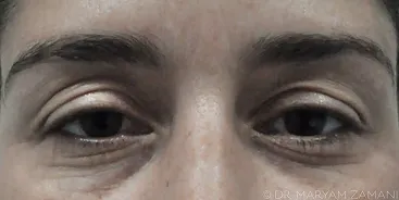 Close-up of a person's eyes showing natural skin texture and slight under-eye shadows.