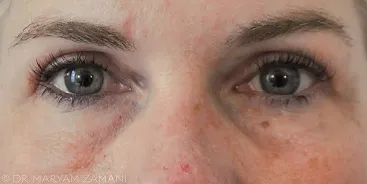 Close-up of a person's face showing eyes with visible skin texture, freckles, and slight redness on the nose.