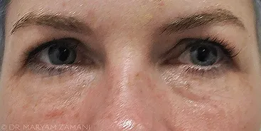 Close-up of a person's eyes and upper nose showing natural skin texture and light wrinkles.