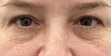 Close-up of human eyes and upper nose area showing natural skin texture and wrinkles.