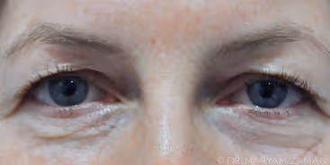 Close-up of a woman's eyes showing visible eyelid skin and wrinkles around the eyes.