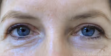 Close-up of a person's blue eyes and upper face showing clear skin with subtle wrinkles around the eyes.