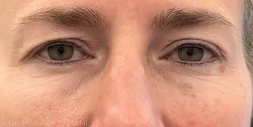 Close-up of a person's eyes showing natural skin texture and light eye color.