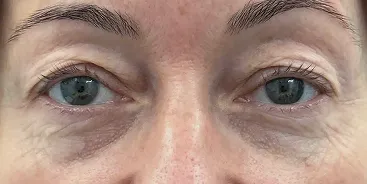 Close-up of a person's eyes and upper eyelids showing natural skin texture and blue-green irises.