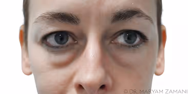 Close-up of a person's face showing dark circles and puffiness under the eyes.