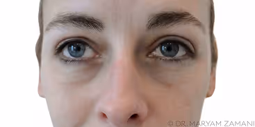 Close-up of a person's blue eyes and upper nose area showing natural skin texture.