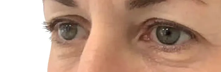 Close-up of a person's eyes showing smooth upper eyelids and natural skin texture.