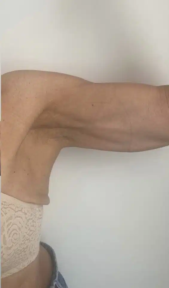 Side view of a bent arm showing toned upper arm muscles and ribs against a plain background.
