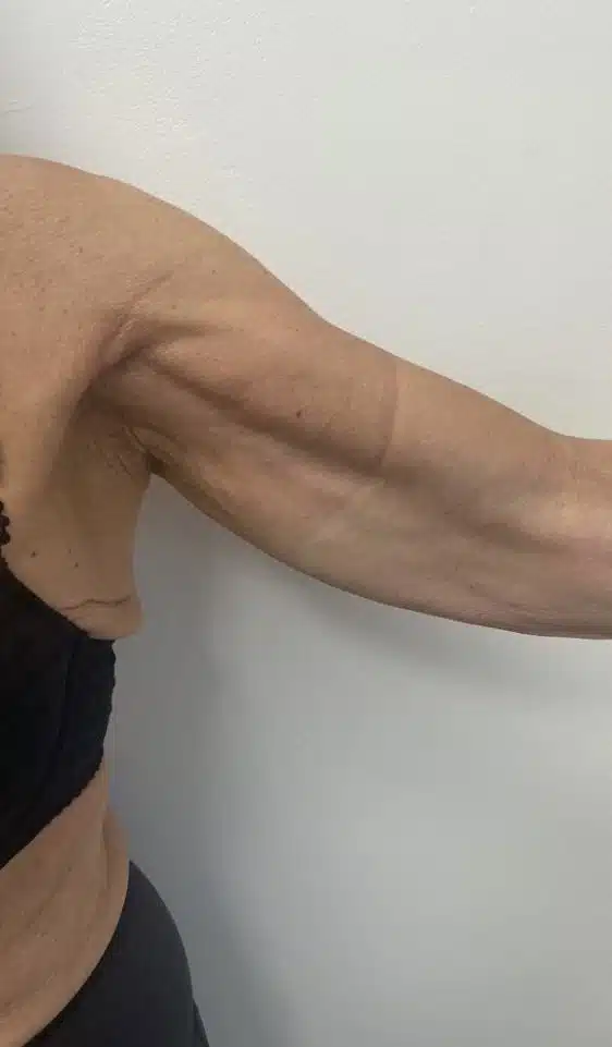 Close-up of a person's flexed upper arm showing defined muscle and skin texture.