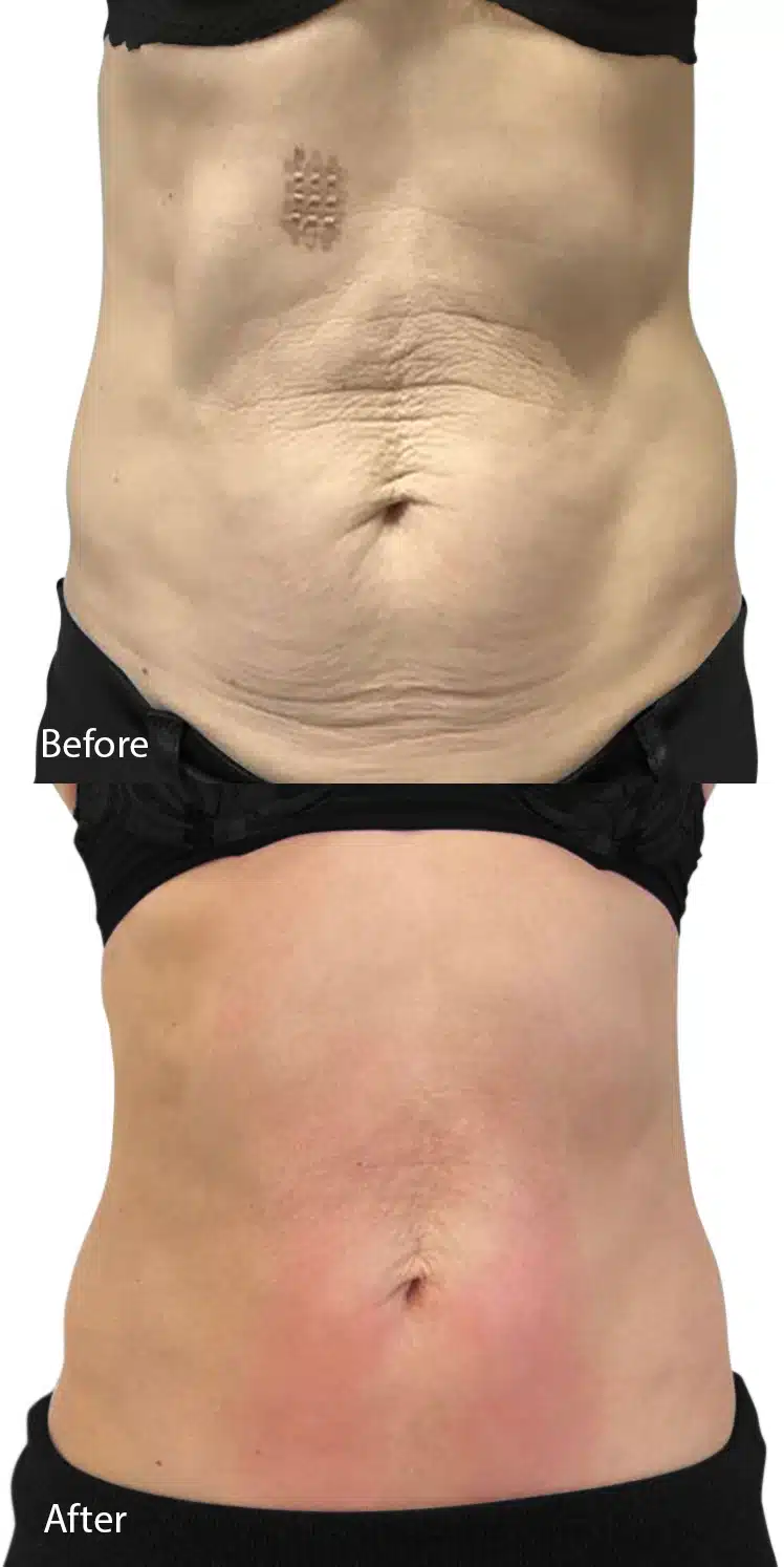 Before and after comparison of a person's abdomen showing reduced skin wrinkles and improved smoothness after treatment.