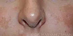 Close-up of a person's nose and cheeks showing uneven skin tone and patches of melasma hyperpigmentation.