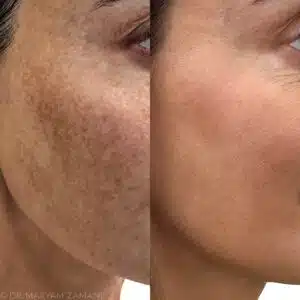 Close-up comparison of a person's cheek before and after skin treatment showing reduction of dark spots and smoother complexion.