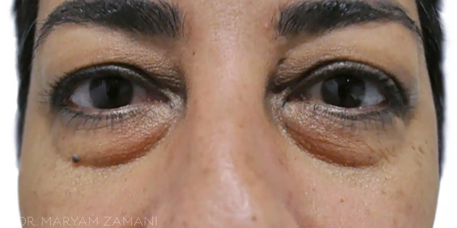 Close-up of a person's eyes with prominent under-eye bags and a small dark mole below the left eye.