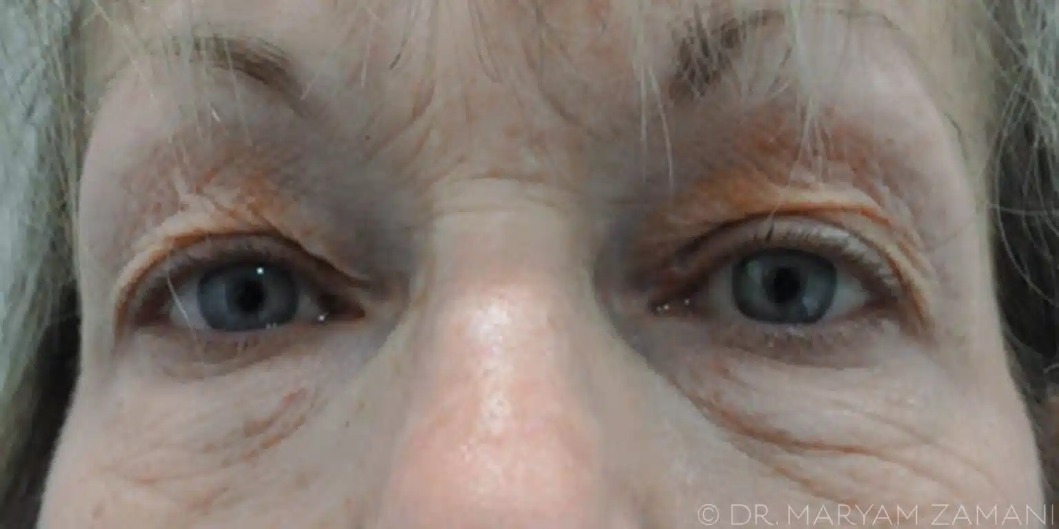 Close-up of mature person's blue eyes showing wrinkles and fine lines around the eyes.