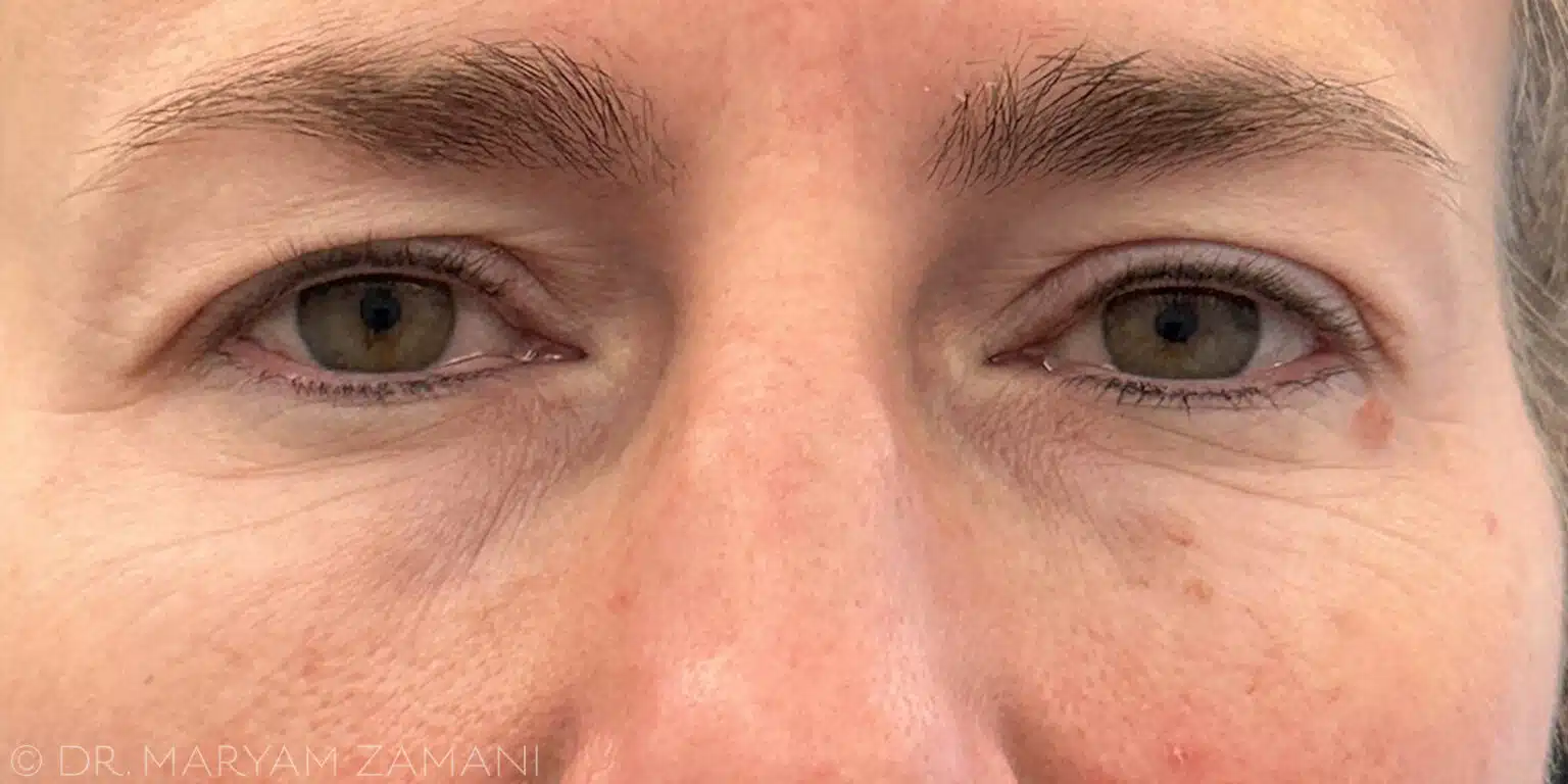 Close-up of a human face focusing on the eyes and nose, showing natural skin texture and freckles.