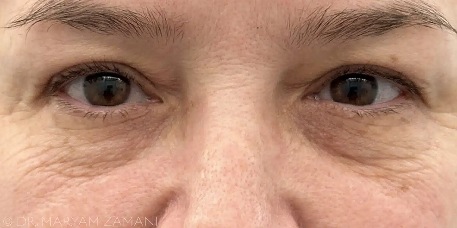 Close-up of a person's eyes and nose showing fine wrinkles and slight puffiness under the eyes.