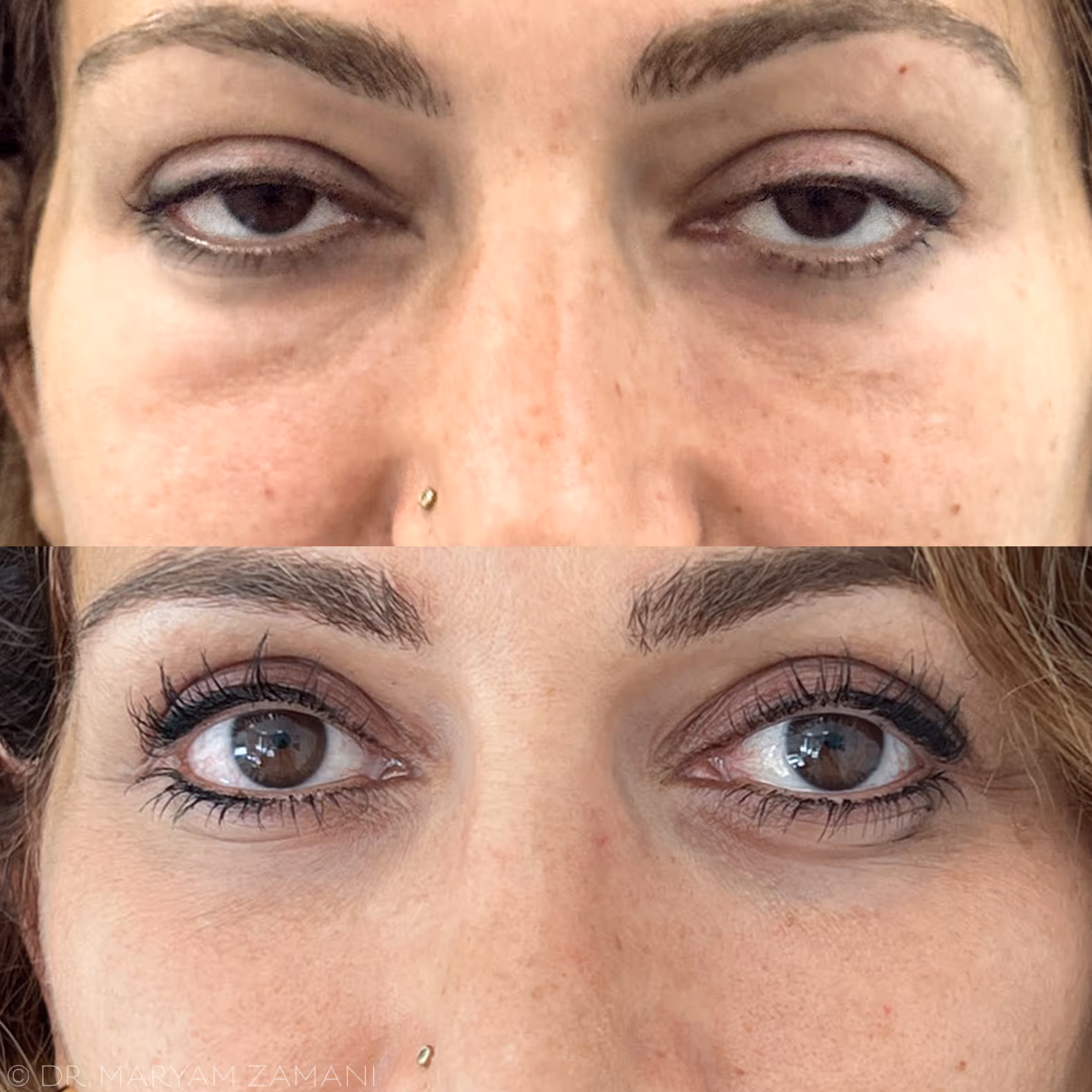 Close-up comparison photo showing a woman's eyes before and after ptosis repair surgery.