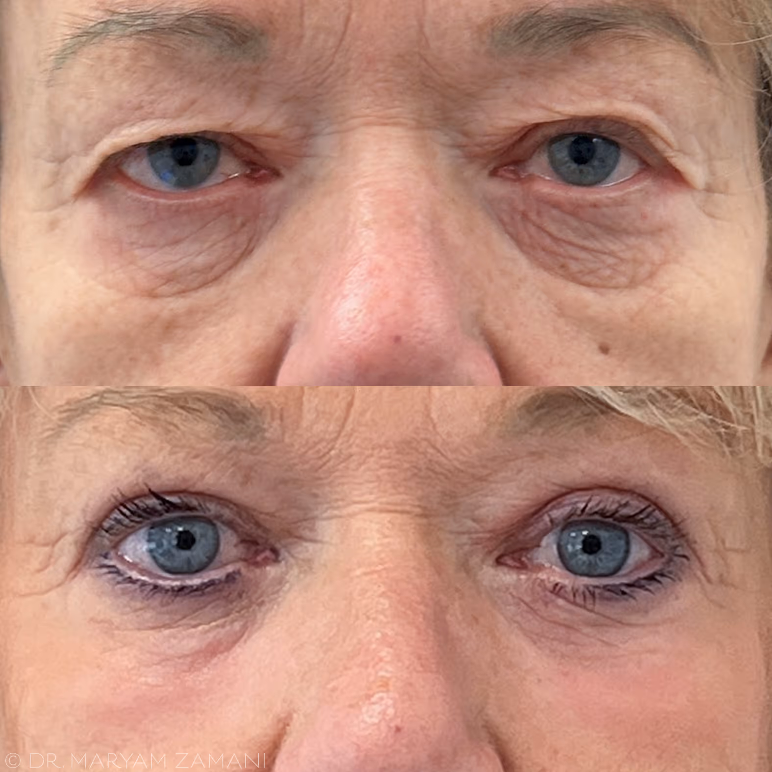 Close-up comparison of a person's eyes before and after upper eyelid surgery, showing a more open and youthful appearance with eyeliner applied after.