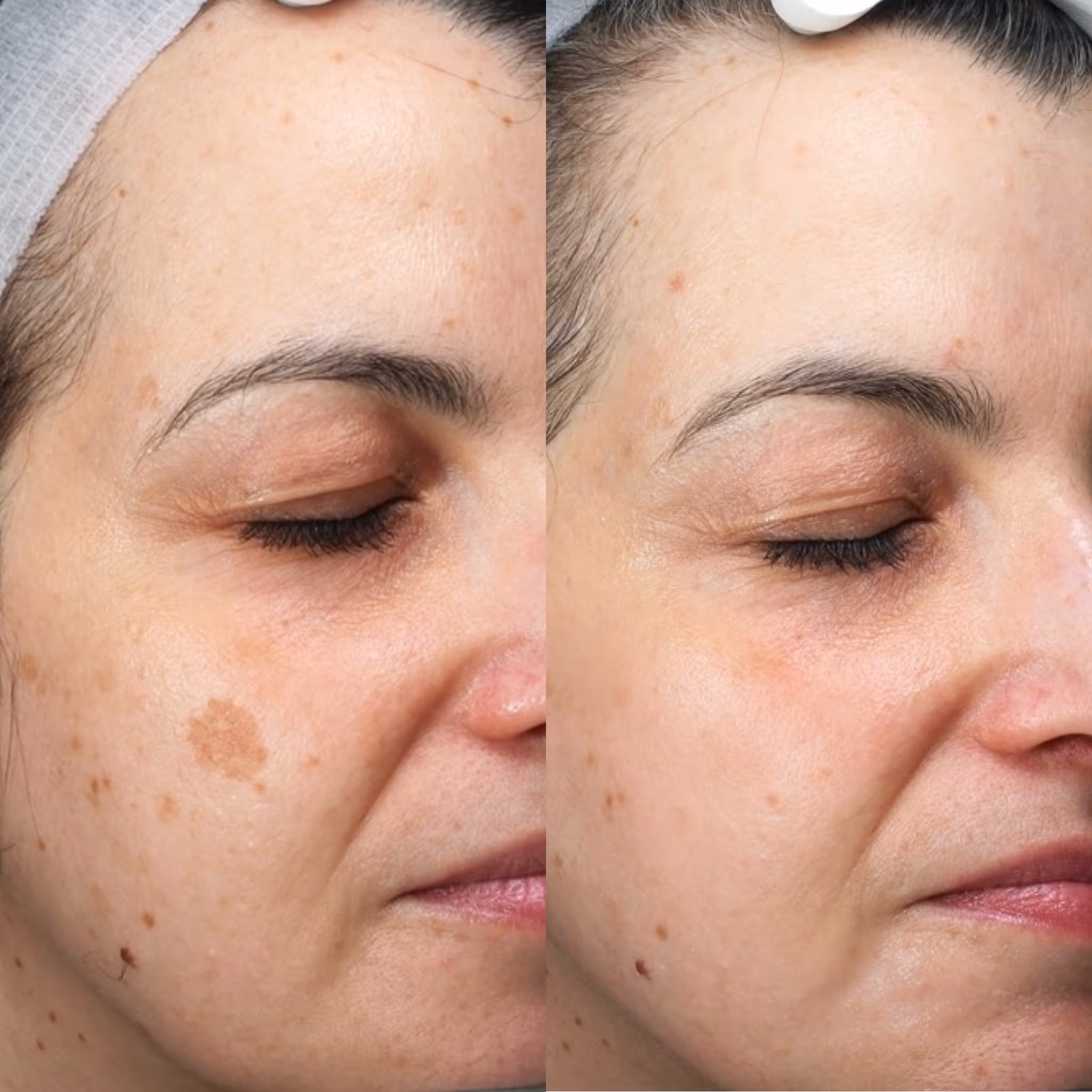 Side-by-side close-up of a woman's face showing reduction of dark spots and uneven skin tone after treatment.
