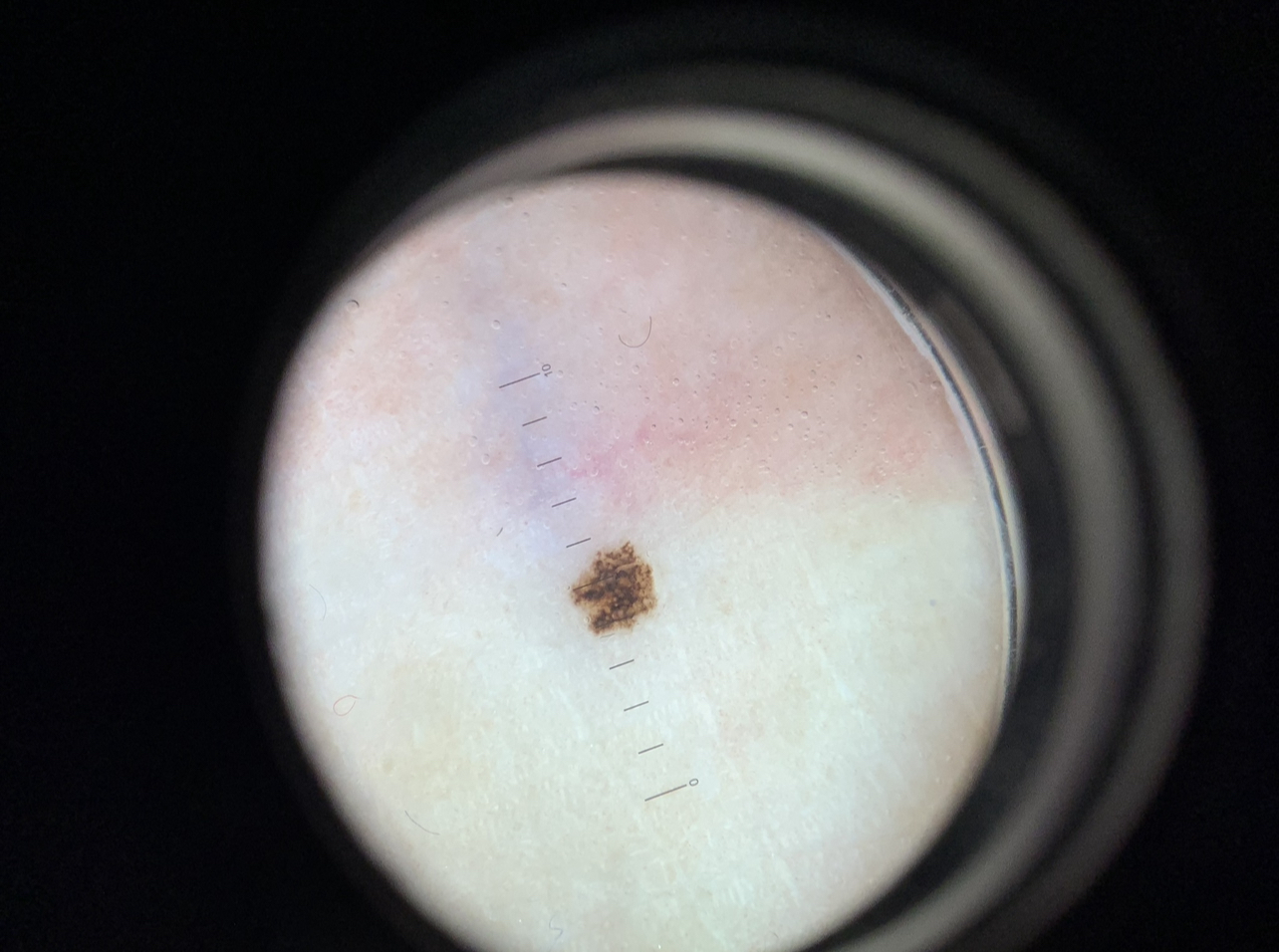 Close-up of a skin mole under a dermatoscope showing a dark brown irregularly shaped spot on light skin.