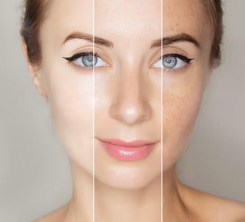 Woman's face divided into three sections showing skin transformation from acne and freckles to clear, smooth skin with makeup.