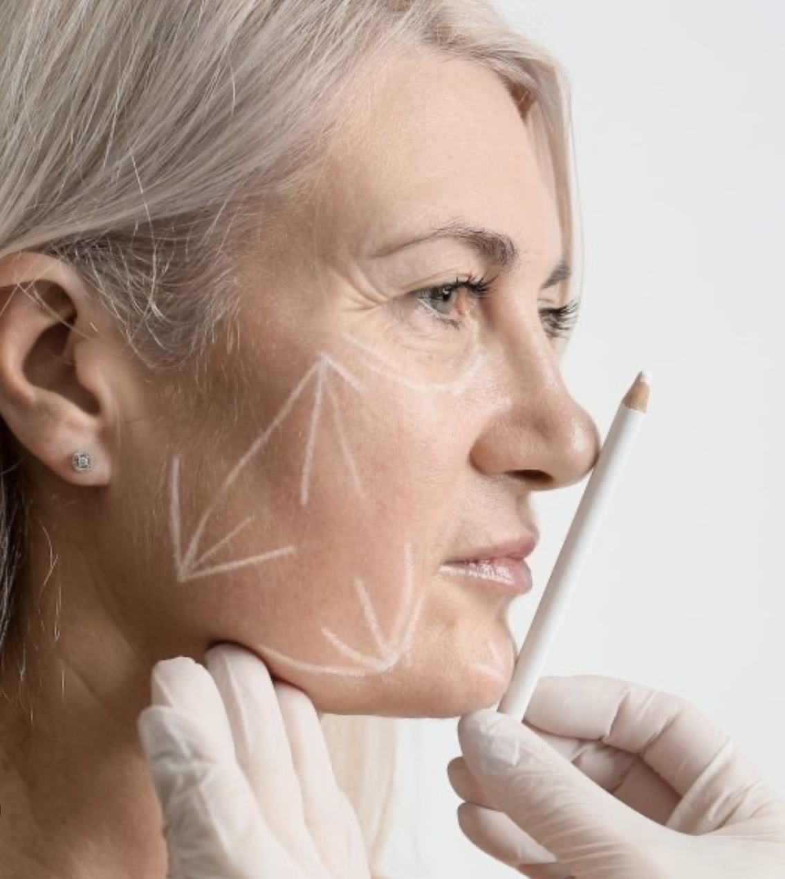 Close-up of a woman’s face with white markings indicating cosmetic surgery areas, while a gloved hand holds a white pencil near her jawline.