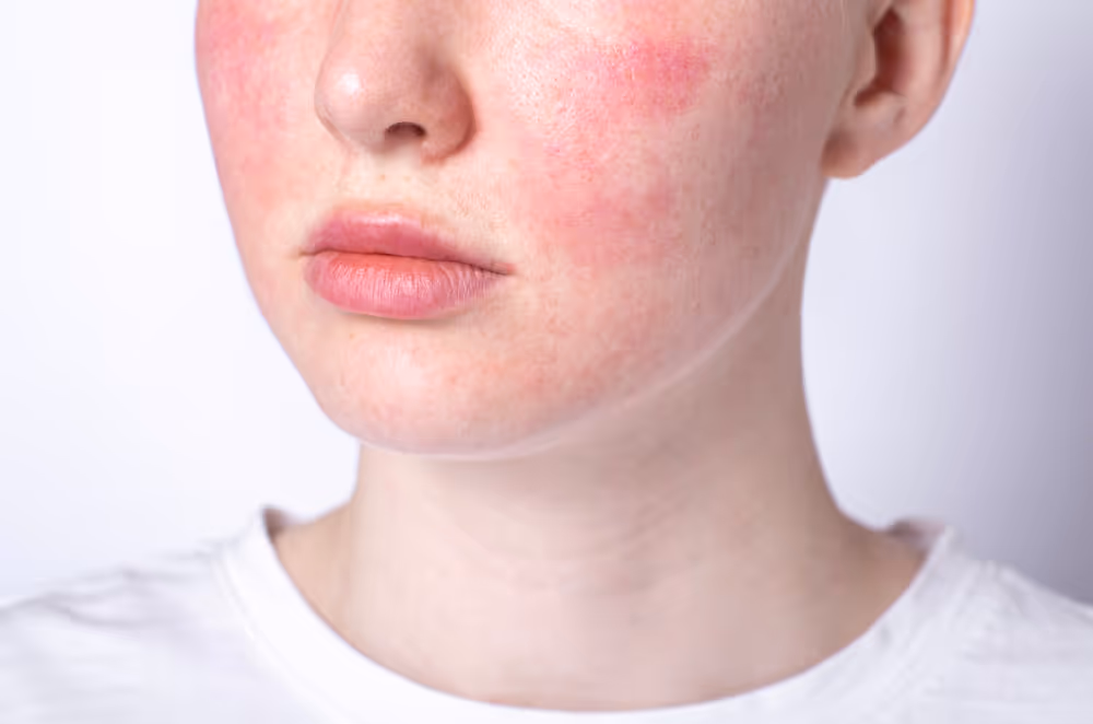 Close-up of the lower face of a person with red, irritated skin and patches of rosacea on the cheeks.