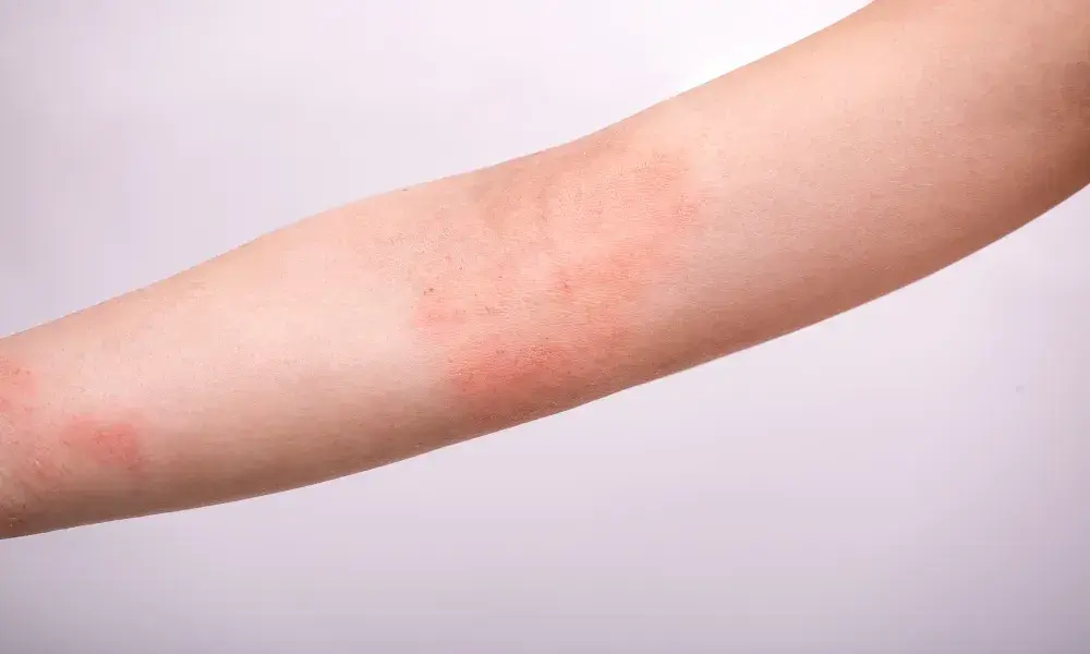 Forearm with red, inflamed patches of skin indicating dermatitis or eczema.