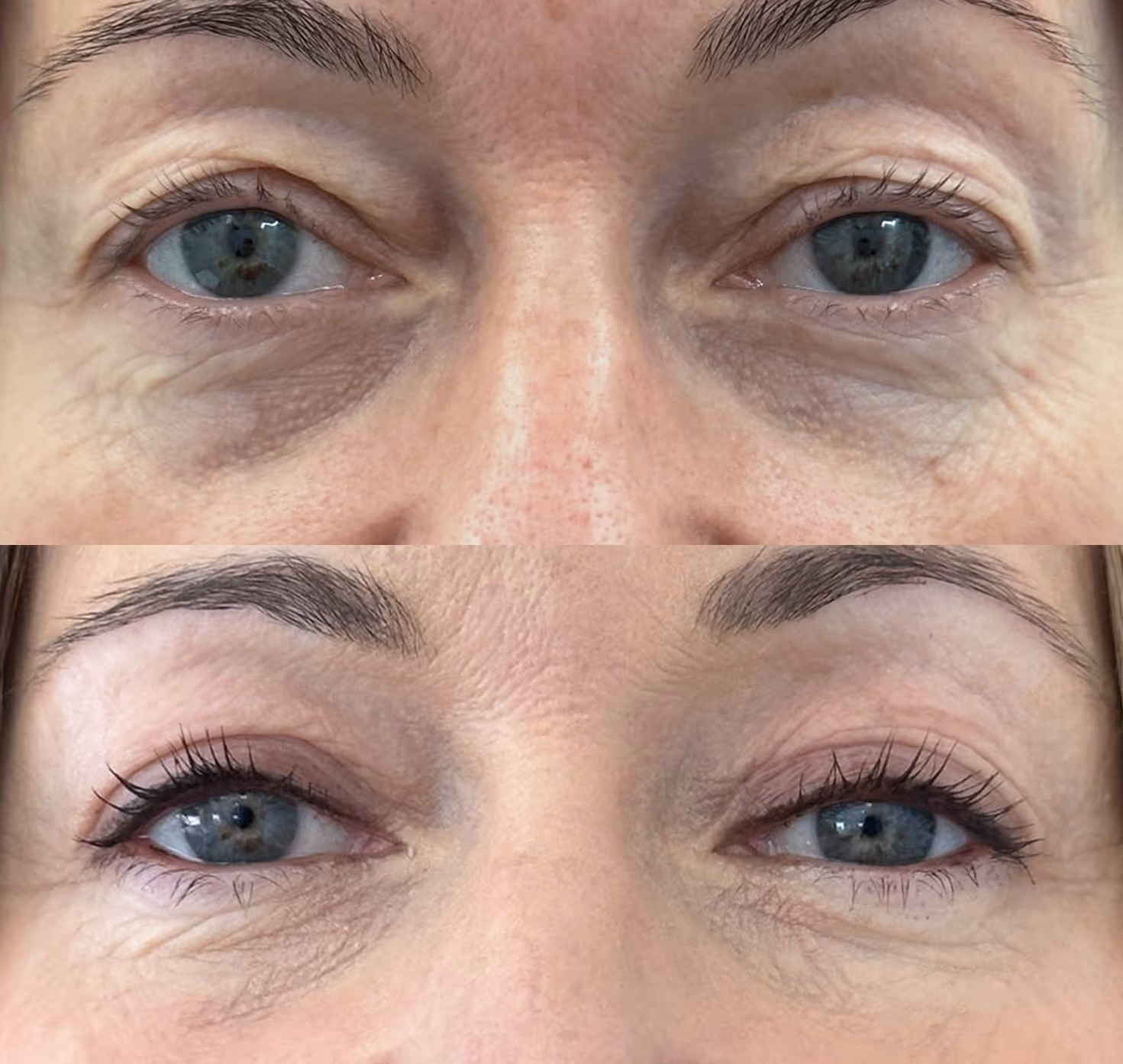 Close-up of a person's eyes showing a before and after comparison of upper eyelid blepharoplasty with reduced eyelid droop and smoother skin post-surgery.