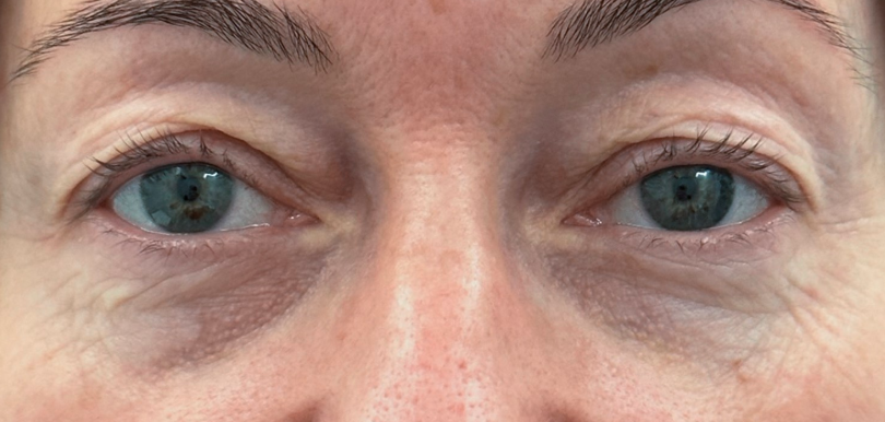 Close-up of a person's blue eyes with visible upper eyelids, light wrinkles, and skin details around the eyes.