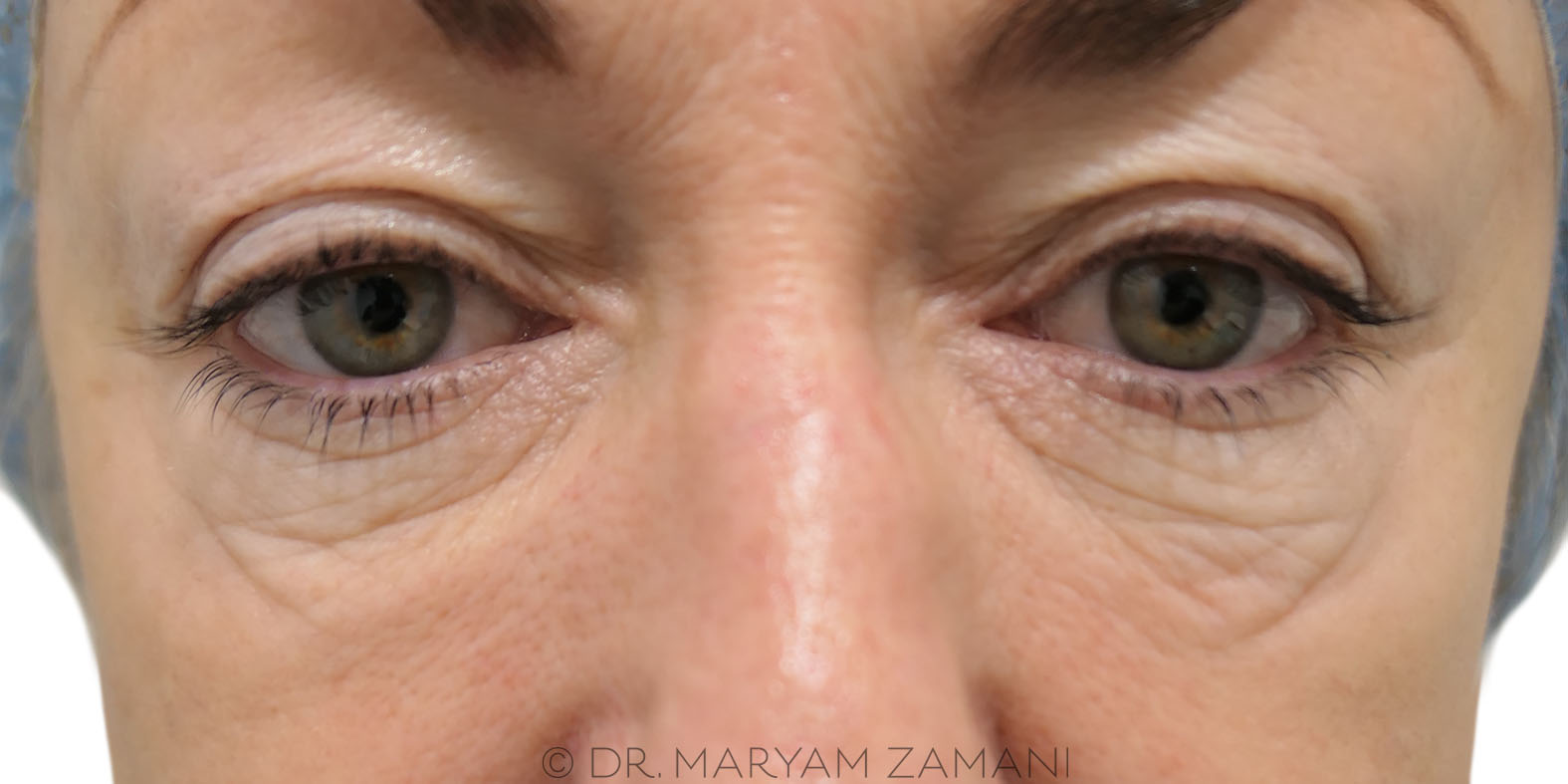 Close-up of a middle-aged woman's eyes showing fine wrinkles and natural skin texture.