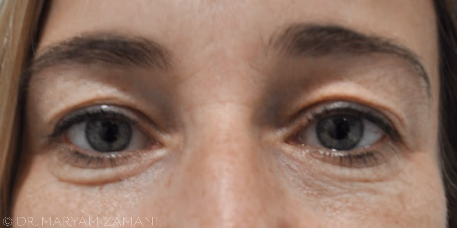 Close-up of a woman's eyes with gray irises and natural skin texture.