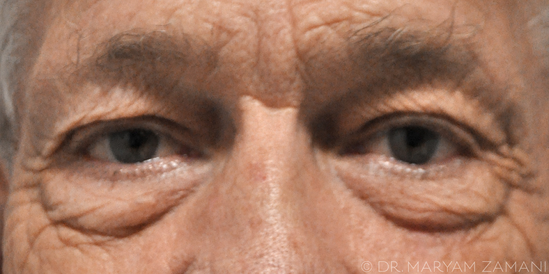 Close-up of an older person's eyes and upper nose with visible wrinkles around the eyes.
