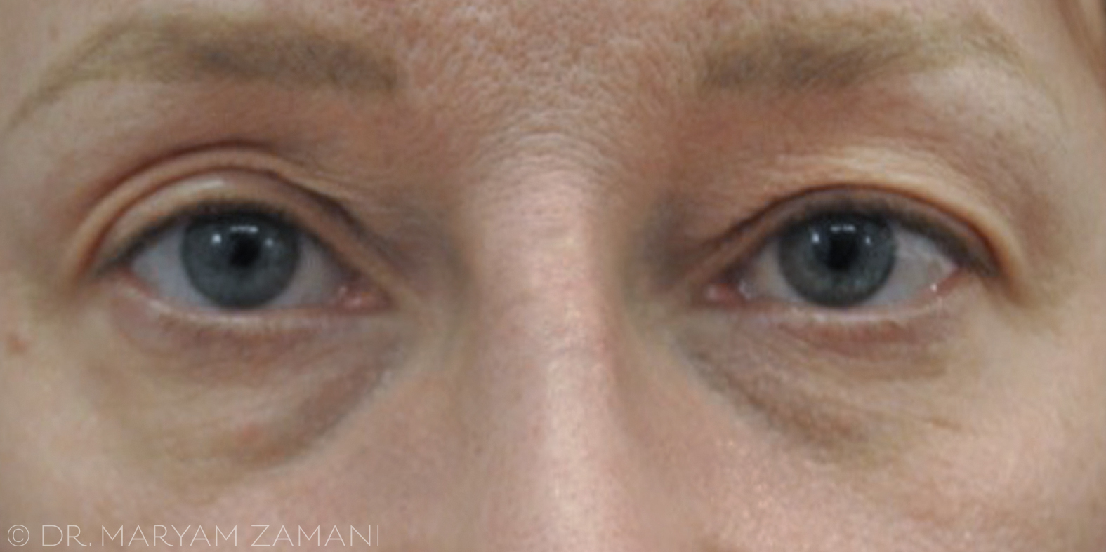 Close-up of a person's eyes showing light blue irises and visible fine wrinkles on the skin around them.