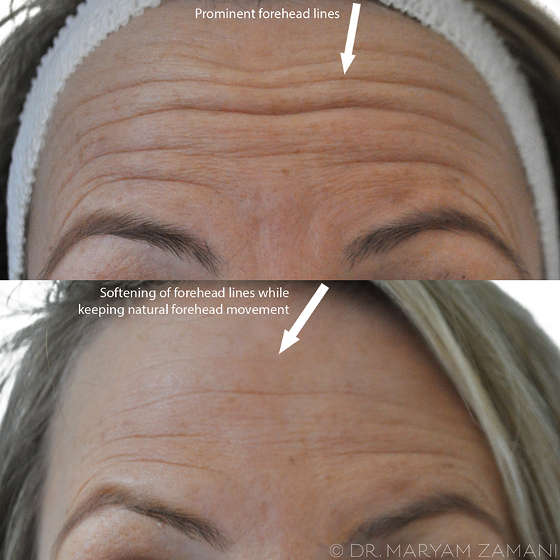 Comparison of a woman's forehead showing prominent forehead lines in the top image and softened forehead lines with natural movement in the bottom image.