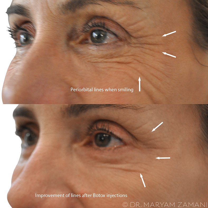 Side-by-side close-up images of a person's eye area showing periorbital wrinkles when smiling before and improvement of lines after Botox injections.