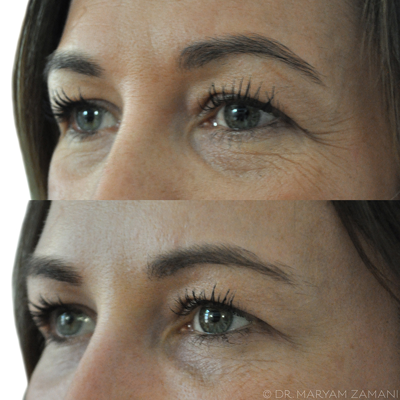 Close-up comparison of a woman's eyes and upper cheeks showing reduced wrinkles and smoother skin in the lower image.