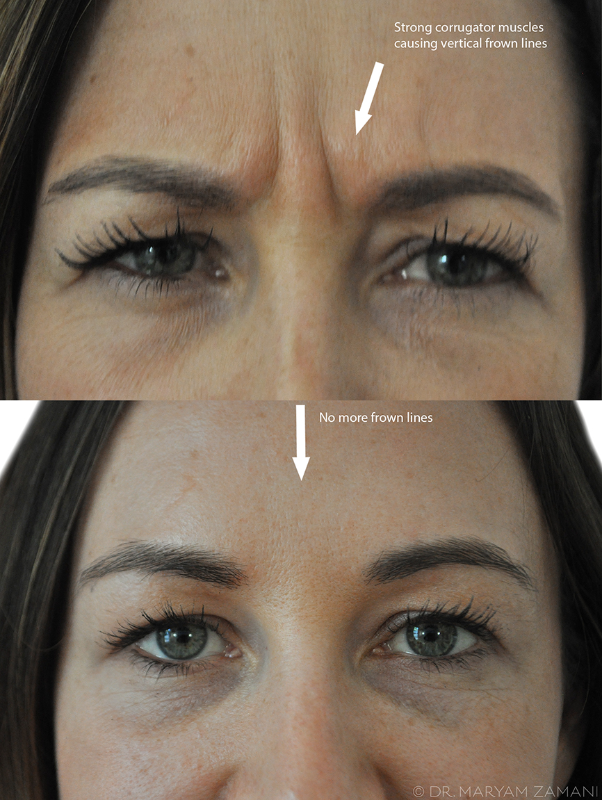 Before and after close-up images of a woman's forehead showing vertical frown lines caused by strong corrugator muscles in the top image and no frown lines in the bottom image.
