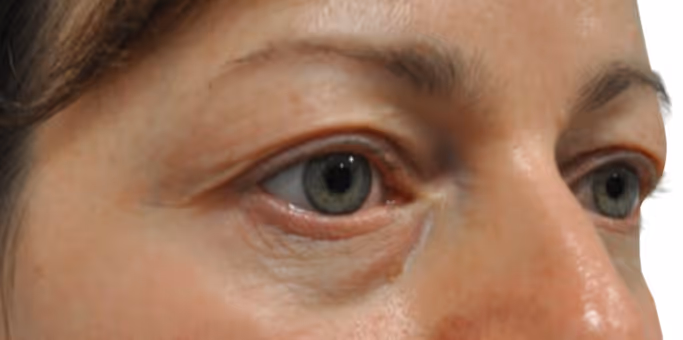 Close-up of a person's face focusing on green eyes and surrounding skin.