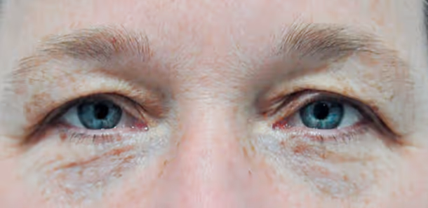 Close-up of a person's blue eyes with visible wrinkles and light skin.