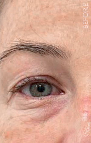 Close-up of a mature person's eye area with visible wrinkles and fine lines, labeled 'Before'.