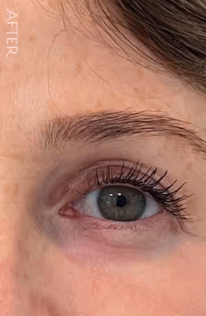 Close-up of a green eye with long eyelashes and smooth skin around it after treatment.