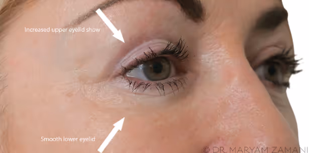 Close-up of a woman's face showing increased upper eyelid and smooth lower eyelid with labeled arrows.