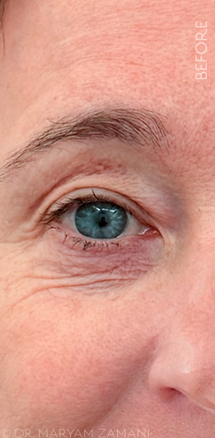 Close-up of a person's eye area showing wrinkles and fine lines under the eye labeled 'BEFORE'.