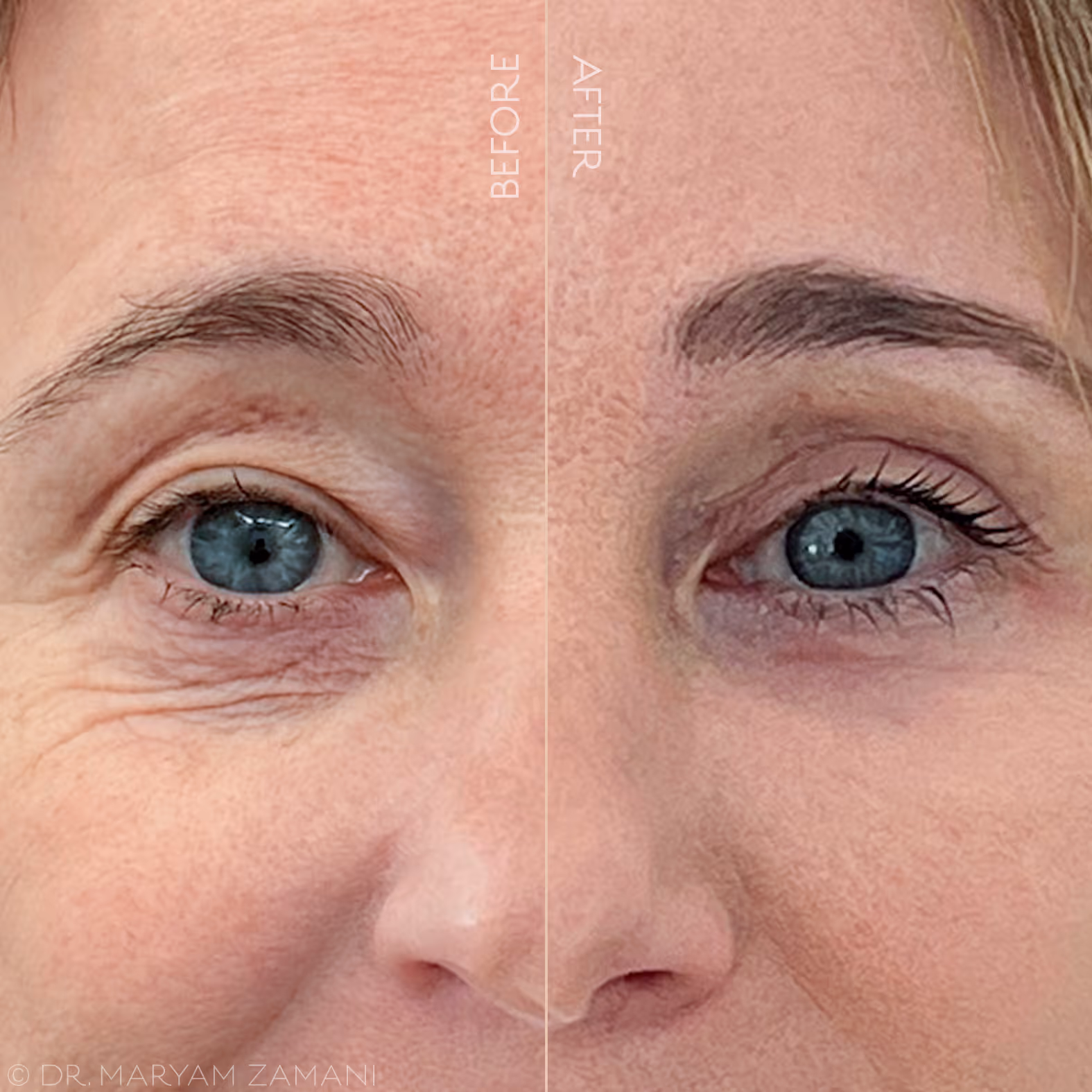 Close-up comparison of a woman's eye area showing visible wrinkles and puffiness before and smoother skin with makeup enhancement after.